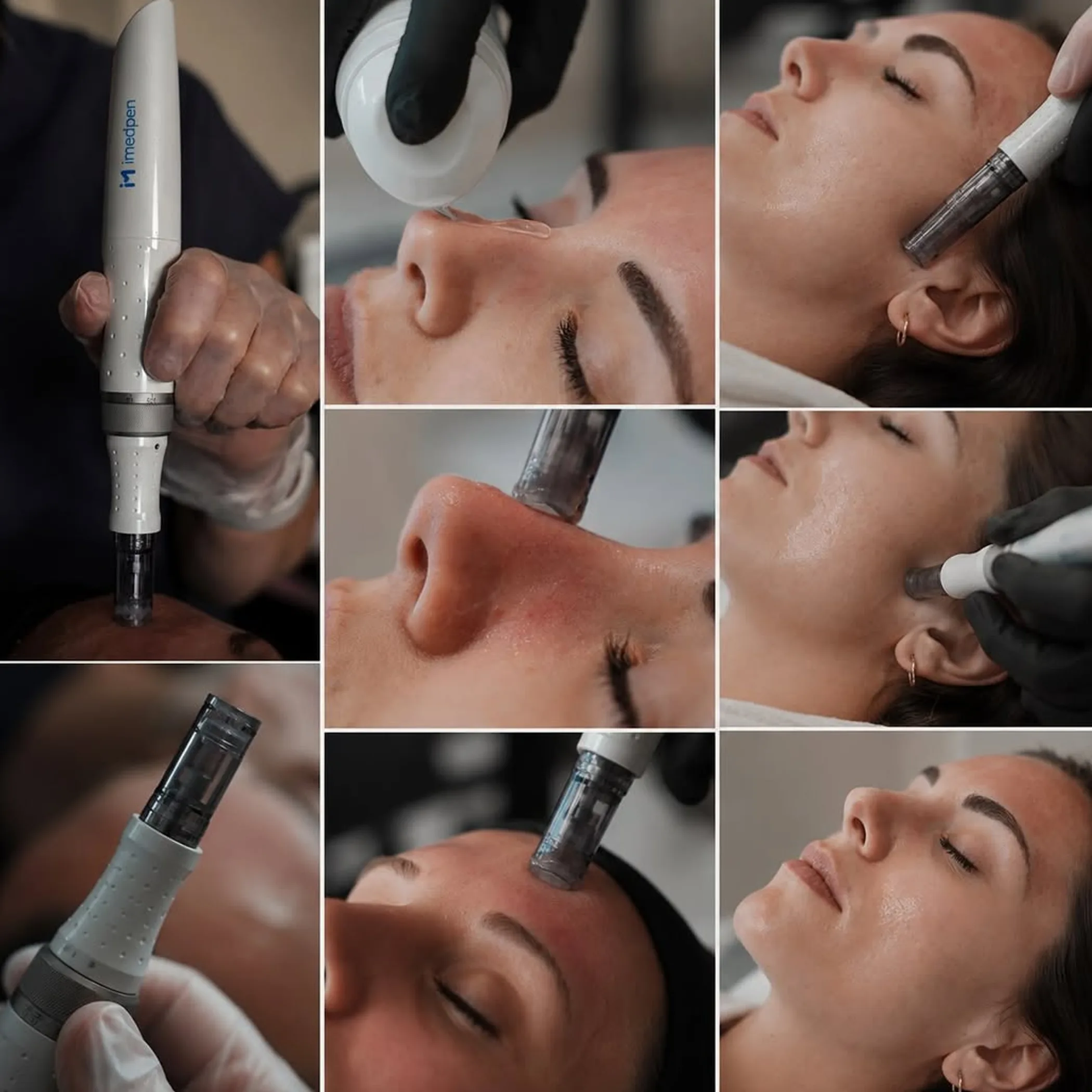 microneedling procedure on skin
